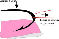 Извлечение крючка без помощи компаньонов