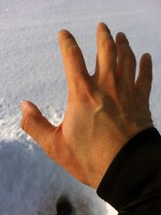 Envision Ice Guard след на руке от манжеты